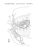 METHODS OF SECURING A CANNULA ASSEMBLY, IMPLANTING A CIRCULATORY ASSIST     SYSTEM AND CROSSING A TISSUE BARRIER diagram and image