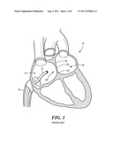 OPTICAL SYSTEM AND METHOD FOR LOCALIZING THE FOSSA OVALIS DURING     TRANS-SEPTAL PROCEDURES diagram and image