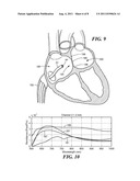 OPTICAL SYSTEM AND METHOD FOR LOCALIZING THE FOSSA OVALIS DURING     TRANS-SEPTAL PROCEDURES diagram and image