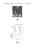 METHOD AND APPARATUS FOR QUANTIFICATION OF CARDIAC WALL MOTION ASYNCHRONY diagram and image