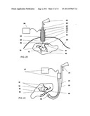 MEDICAL MEASURING SYSTEM, METHOD FOR SURGICAL INTERVENTION AS WELL AS USE     OF A MEDICAL MEASURING SYSTEM diagram and image