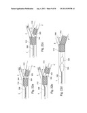 POSITIONING DEVICE FOR OSTIAL LESIONS diagram and image