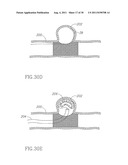 POSITIONING DEVICE FOR OSTIAL LESIONS diagram and image