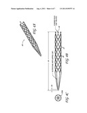 METHOD OF RESTORING BLOOD FLOW THROUGH AN OBSTRUCTED BLOOD VESSEL OF THE     BRAIN diagram and image