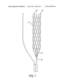 METHOD OF RESTORING BLOOD FLOW THROUGH AN OBSTRUCTED BLOOD VESSEL OF THE     BRAIN diagram and image