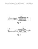 METHOD OF RESTORING BLOOD FLOW THROUGH AN OBSTRUCTED BLOOD VESSEL OF THE     BRAIN diagram and image