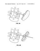 SYSTEM AND METHOD FOR STABILIZING A POSTERIOR FUSION OVER MOTION SEGMENTS diagram and image