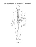 LEAD HAVING EXPANDABLE DISTAL PORTION diagram and image