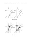 DIRECTIONAL EXPANSION OF INTRALUMINAL DEVICES diagram and image