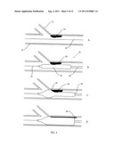 DIRECTIONAL EXPANSION OF INTRALUMINAL DEVICES diagram and image