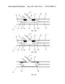 DIRECTIONAL EXPANSION OF INTRALUMINAL DEVICES diagram and image