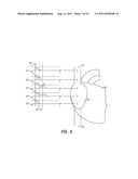 APPARATUS AND METHOD FOR CATHETER NAVIGATION AND TIP LOCATION diagram and image