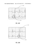APPARATUS AND METHOD FOR CATHETER NAVIGATION AND TIP LOCATION diagram and image