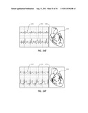 APPARATUS AND METHOD FOR CATHETER NAVIGATION AND TIP LOCATION diagram and image