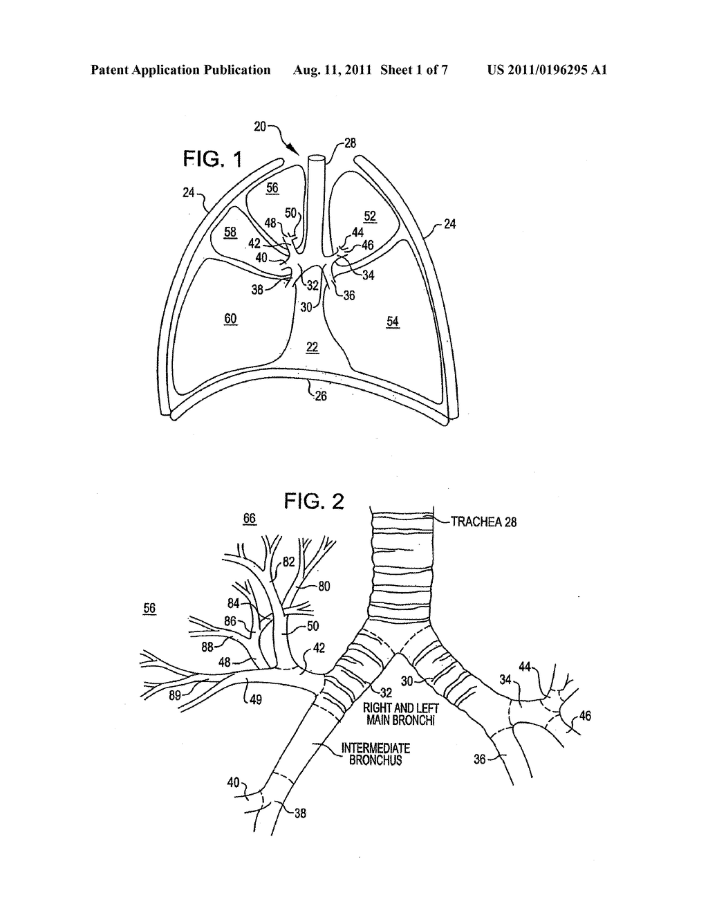 DEVICE AND METHOD FOR INTRA-BRONCHIAL PROVISION OF A THERAPEUTIC AGENT - diagram, schematic, and image 02