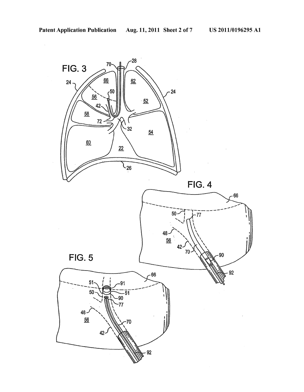 DEVICE AND METHOD FOR INTRA-BRONCHIAL PROVISION OF A THERAPEUTIC AGENT - diagram, schematic, and image 03