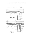 Navigation Guide Wire Through an Anatomical Structure Having Branched     Ducts diagram and image