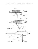 Navigation Guide Wire Through an Anatomical Structure Having Branched     Ducts diagram and image