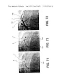 Navigation Guide Wire Through an Anatomical Structure Having Branched     Ducts diagram and image