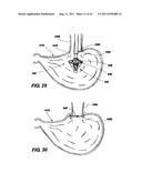 POST-OPERATIVE ADJUSTMENT TOOL, MINIMALLY INVASIVE ATTACHMENT APPARATUS,     AND ADJUSTABLE TRICUSPID RING diagram and image