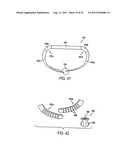 POST-OPERATIVE ADJUSTMENT TOOL, MINIMALLY INVASIVE ATTACHMENT APPARATUS,     AND ADJUSTABLE TRICUSPID RING diagram and image