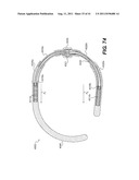 POST-OPERATIVE ADJUSTMENT TOOL, MINIMALLY INVASIVE ATTACHMENT APPARATUS,     AND ADJUSTABLE TRICUSPID RING diagram and image