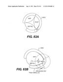 POST-OPERATIVE ADJUSTMENT TOOL, MINIMALLY INVASIVE ATTACHMENT APPARATUS,     AND ADJUSTABLE TRICUSPID RING diagram and image