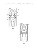 ARTIFICIAL VALVE diagram and image