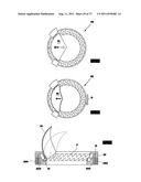 ARTIFICIAL VALVE diagram and image