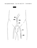 ARTIFICIAL VALVE diagram and image