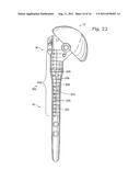 BONE PROSTHESIS diagram and image