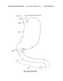 ARTIFICIAL STOMACH diagram and image