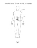 ARTIFICIAL STOMACH diagram and image