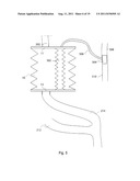 ARTIFICIAL STOMACH diagram and image