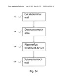 ARTIFICIAL STOMACH diagram and image