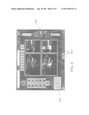 LAPAROSCOPIC HIFU PROBE diagram and image