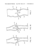 Apparatus and Methods for Creating a Venous Valve from Autologous Tissue diagram and image