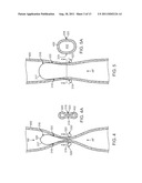 Apparatus and Methods for Creating a Venous Valve from Autologous Tissue diagram and image