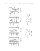 Apparatus and Methods for Creating a Venous Valve from Autologous Tissue diagram and image