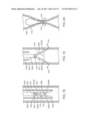 Apparatus and Methods for Creating a Venous Valve from Autologous Tissue diagram and image