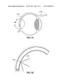 Methods And Devices For Delivering Appropriate Minimally-Invasive     Extraocular Radiation diagram and image