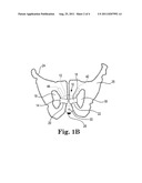 IMPLANTABLE URETHRAL PROSTHESIS HAVING TABLE MEMBER diagram and image