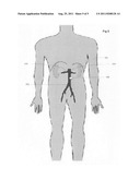 System with a reservoir for perfusion management diagram and image