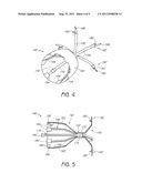 BRONCHOSCOPIC REPAIR OF AIR LEAKS IN A LUNG diagram and image