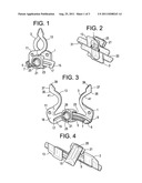 CROSSOVER SPINOUS PROCESS IMPLANT diagram and image