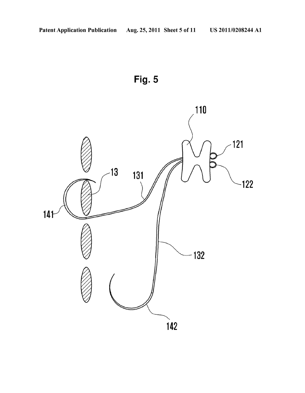 INTERSPINOUS SUPPORT AND METHOD FOR FIXING SAME - diagram, schematic, and image 06