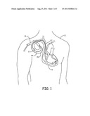 LEAD-CARRIED PROXIMAL ELECTRODE FOR QUADRIPOLAR TRANSTHORACIC IMPEDANCE     MONITORING diagram and image