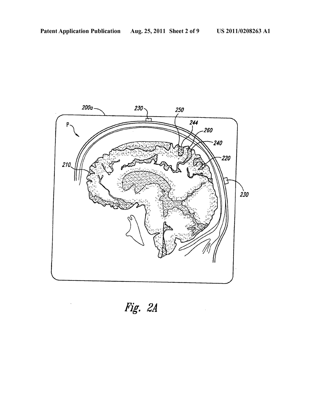 SYSTEM AND METHOD FOR TREATING PARKINSON'S DISEASE AND OTHER MOVEMENT     DISORDERS - diagram, schematic, and image 03