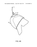 DEVICE AND METHOD FOR REGENERATIVE THERAPY BY HIGH INTENSITY LASER THERAPY diagram and image