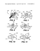 IMPLANTABLE DEVICES FOR CONTROLLING THE SIZE AND SHAPE OF AN ANATOMICAL     STRUCTURE OR LUMEN diagram and image